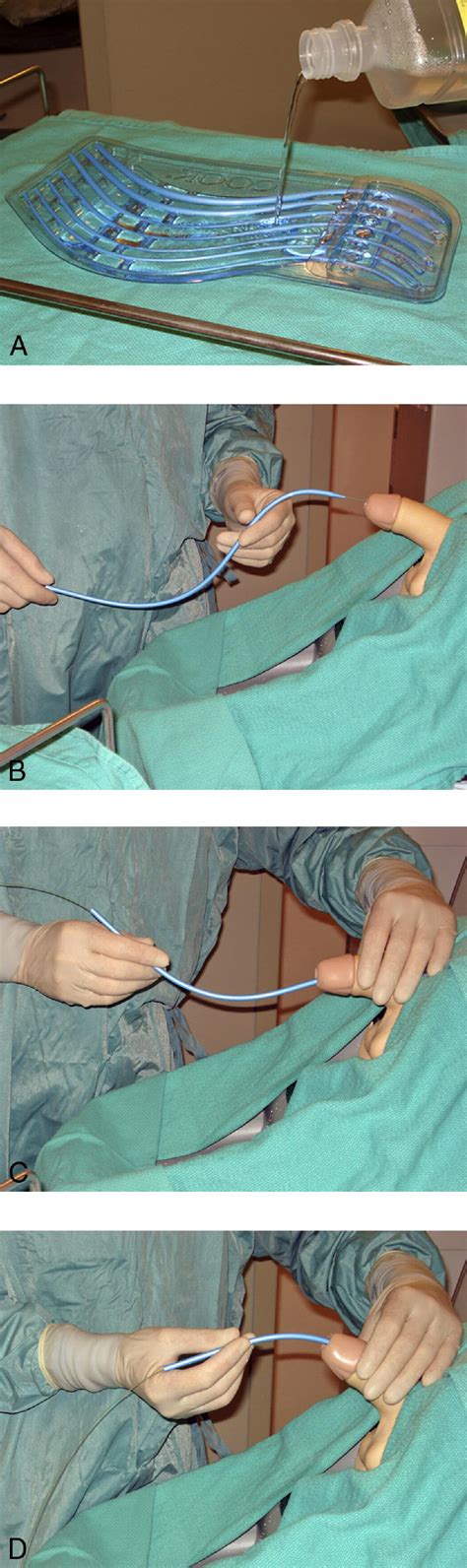 dilator mann|male urethral dilation procedure.